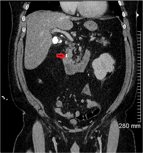 Coronal Ct Abdomen Showing More Calcified Gallstones In The Distal