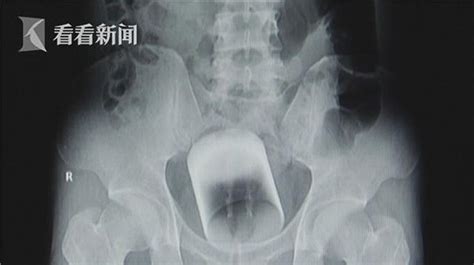 Man Gets Drinking Glass Lodged In Rectum Wont Tell Doctors How It Got There