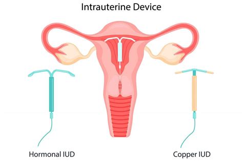 Knowledge On Intrauterine Contraceptive Device Dtap Clinic