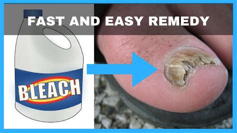 Bleach For Toenail Fungus Before And After My Bios