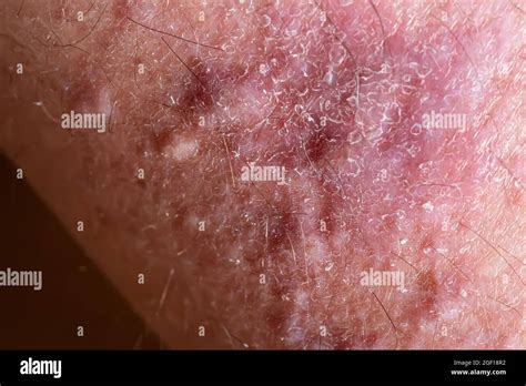 Lichen Planus Leg Hi Res Stock Photography And Images Alamy