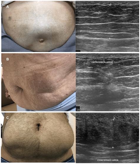 A A Typical Insulin Induced Lipohypertrophy In T2dm Patient With