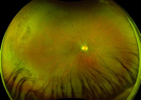 Atrophic Retinal Hole A Pictures Of Hole 2018