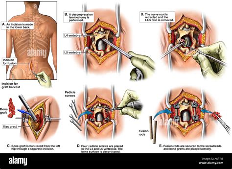 Back Surgery L4 L5 Laminectomy L4 5 Discectomy Diskectomy And