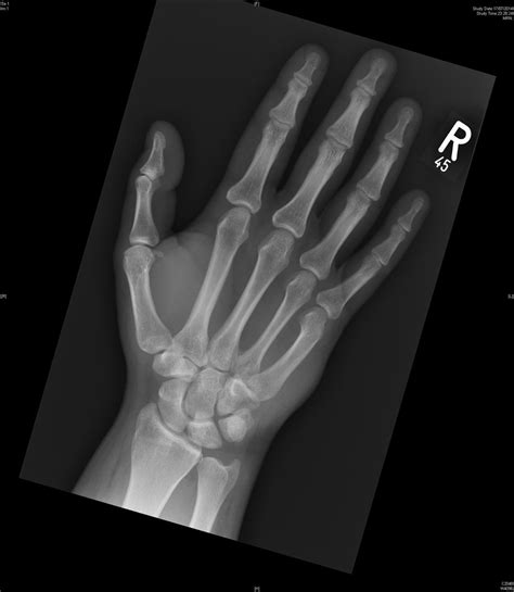 Hamate Body Fracture - Hand - Orthobullets