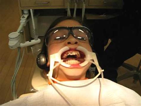 Check spelling or type a new query. Braces Step-by-Step: Step-5 Applying Braces Burleson ...