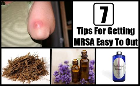 7 Tips For Getting Mrsa Easy To Out Natural Home Remedies And Supplements