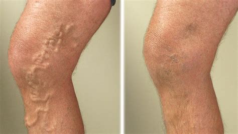 Most varicose veins of the legs are never treated. Enlarged Veins - What Are The Treatments For Varicose ...