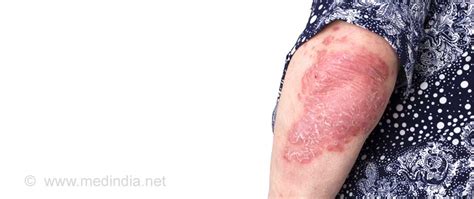 Skin Tuberculosis Causes Symptoms Diagnosis Treatment And Prevention