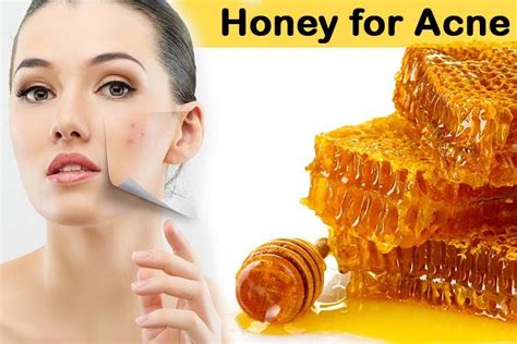 how to use honey to get rid of acne naturally honey for acne homemade acne treatment skin