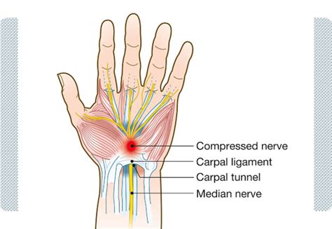 Best Hand Nerve Damage Repair Surgery In Lahore Pakistan