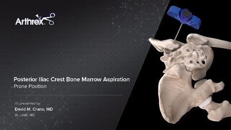 Posterior Iliac Crest Bone Marrow Aspiration Prone Position Youtube