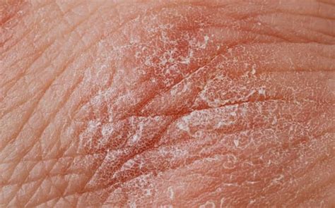 What Causes Dry Patches On Skin And How To Cure At Home