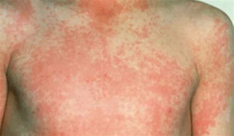 Scarlet Fever Cases Continue To Soar In Kent And These Are The Hotspots
