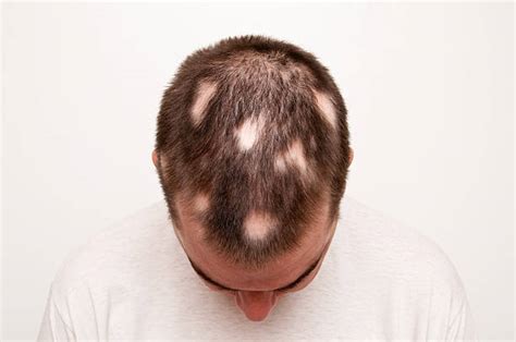 Bald Spot On Top Of Head Discount Deals Save 53 Jlcatjgobmx