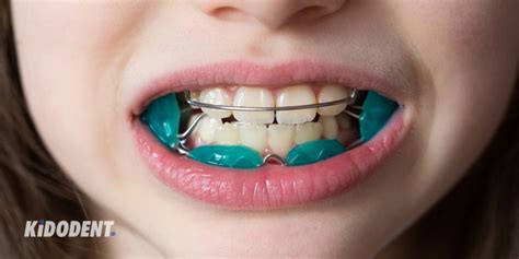 What Is Activator In Orthodontics Kidodent