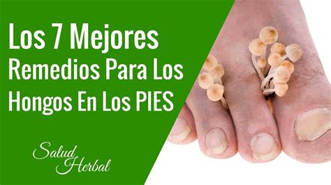 Los Mejores 7 Remedios Para Los Hongos En Los Pies Tratamiento Para