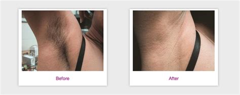 Top considerations for laser hair removal. Used Candela GentleMAX Aesthetic Equipment For Sale