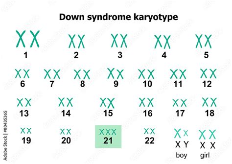 Down Syndrome Karyotype Stock Vector Adobe Stock