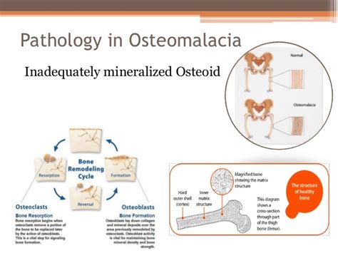 Guide To Osteomalacia All About Bone Health And Joint Care