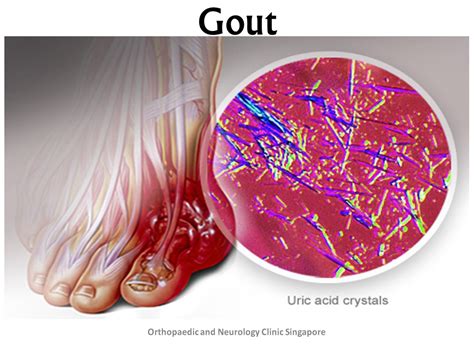 Gout Solution Reliable Sg Gout Specialist Clinic