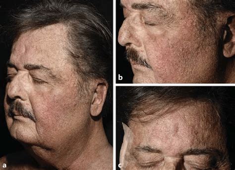 Multiple Asymptomatic Skin Colored Papules Disseminated Over The Face