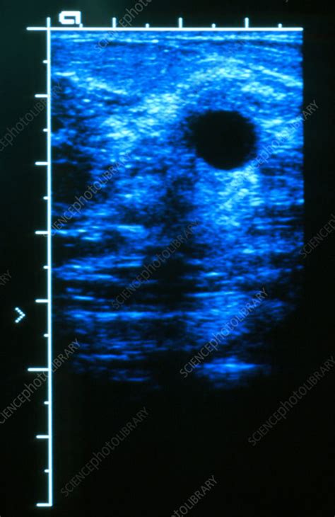 Breast Cyst Ultrasound Stock Image M1220258 Science Photo Library