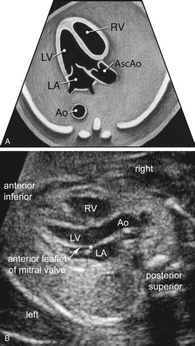 Sonographic Evaluation Of The Fetal Heart Obgyn Key