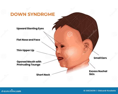 Face Features Of The Baby With Down Syndrome Trisomy 21 Symptoms