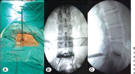 Figure 1 From Percutaneous Endoscopic Interlaminar Discectomy For L5 S1
