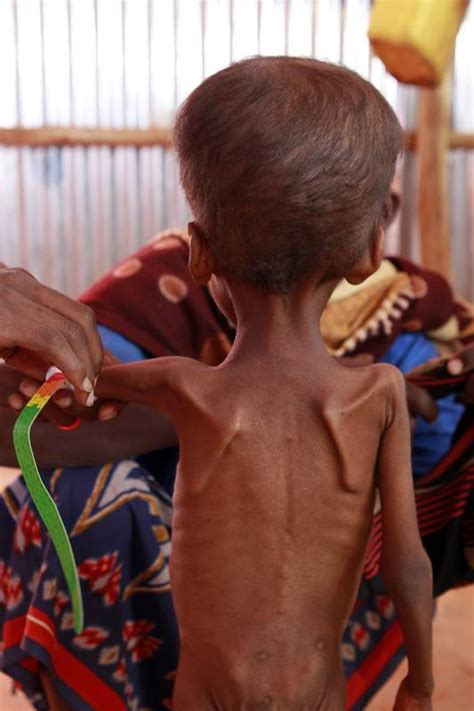 Desnutrição Das Crianças Da Somália Na Maior Crise Humanitária Na África