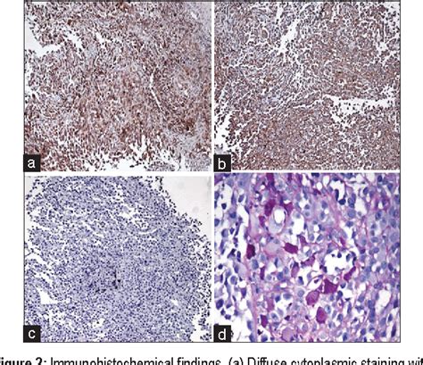 Figure 2 From An Atypical Presentation Of Alveolar Soft Part Sarcoma Of