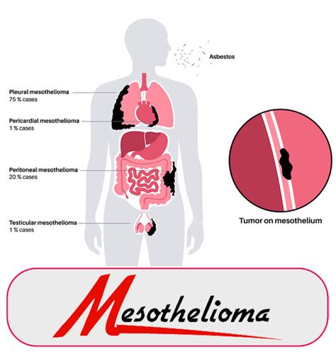 Peritoneal Mesothelioma Clinical Trials And Research Updates