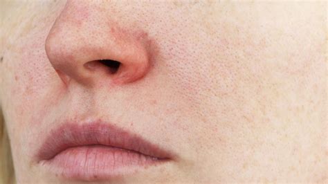 Facial Redness And Veins Victorian Dermal Group