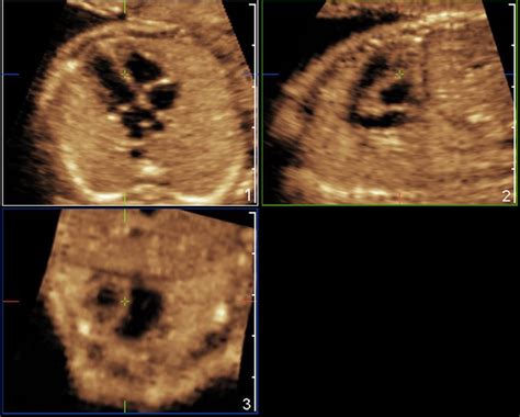 Volumetric Imaging Of The Fetal Heart Fetal Sonography Brain Images
