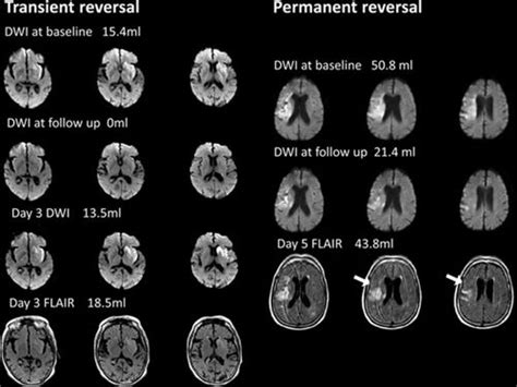 Early Diffusion Weighted Imaging Reversal After Endovascular