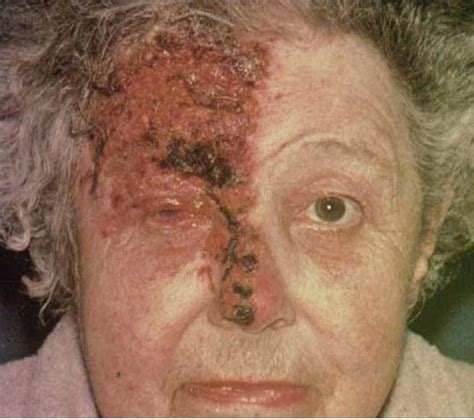 Herpes zoster ophthalmicus (hzo), also known as ophthalmic zoster, is shingles involving the eye. Herpes Zoster (Shingles) - Stepwards