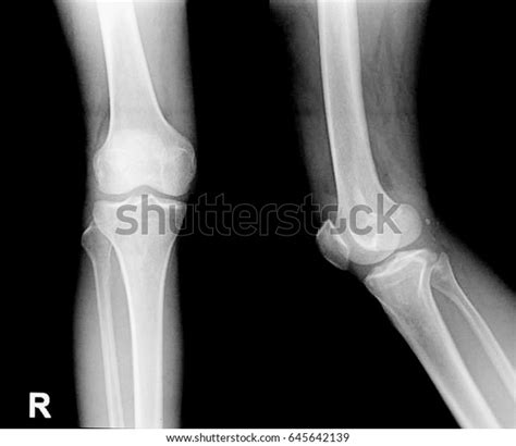 Collection Xray Normal Knee Stock Photo 645642139 Shutterstock