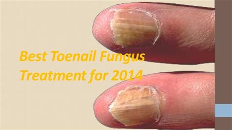 Best Toenail Fungus Treatment For 2014