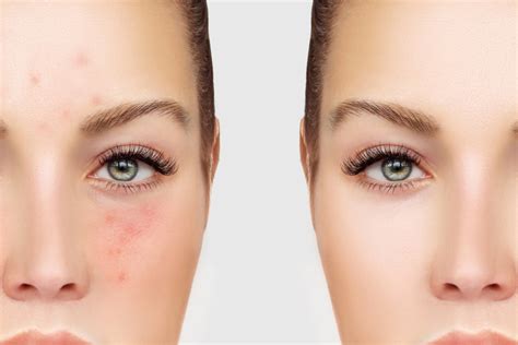 Acne And Rosacea Reno Tahoe Dermatology Best Reno Dermatologist