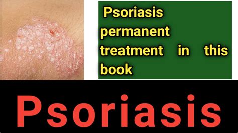 Psoriasis Permanent Treatment Psoriasis Treatment At Home Cure