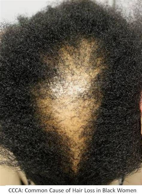 Black hair ranges from relaxed through loosely curled to tight coils and glorious afros. Hair Loss in Black Women: CCCA | Black women hairstyles ...