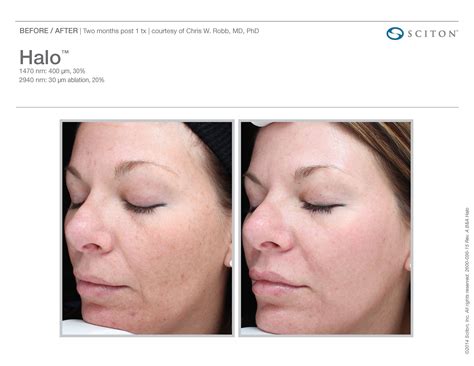 Halo Laser Resurfacing Before After 11 Robinson Fps
