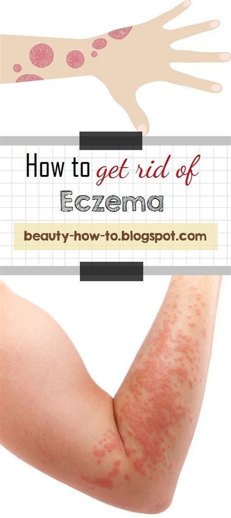 How To Get Rid Of Eczema In 2020 With Images Get Rid Of Eczema