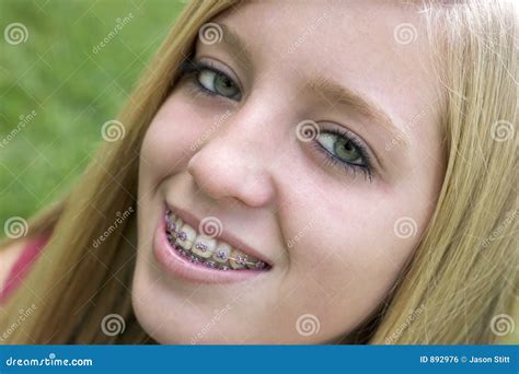 Teen Girls With Braces Facial Telegraph