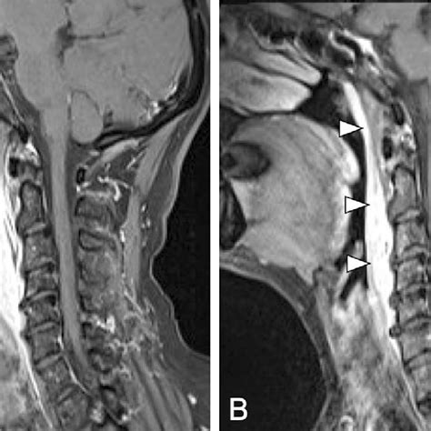 Laryngoscope View Demonstrating Bulging Of Posterior Pharyngeal Wall In