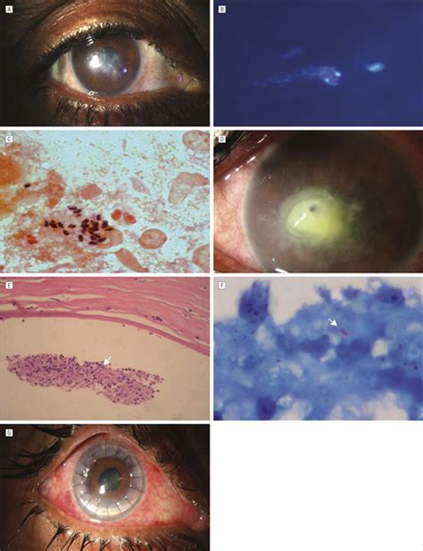 Intraocular Invasion By Microsporidial Spores In A Case Of Stromal