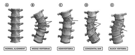 Types Of Scoliosis Curves