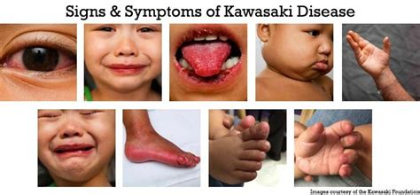 Kawasaki Disease Southern California Integrative Wellness Center