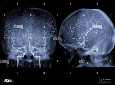 Cerebral Angiography Image From Fluoroscopy In Intervention Radiology Showing Cerebral Artery